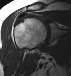 Shoulder MRI T1 Calcific Tendonitis